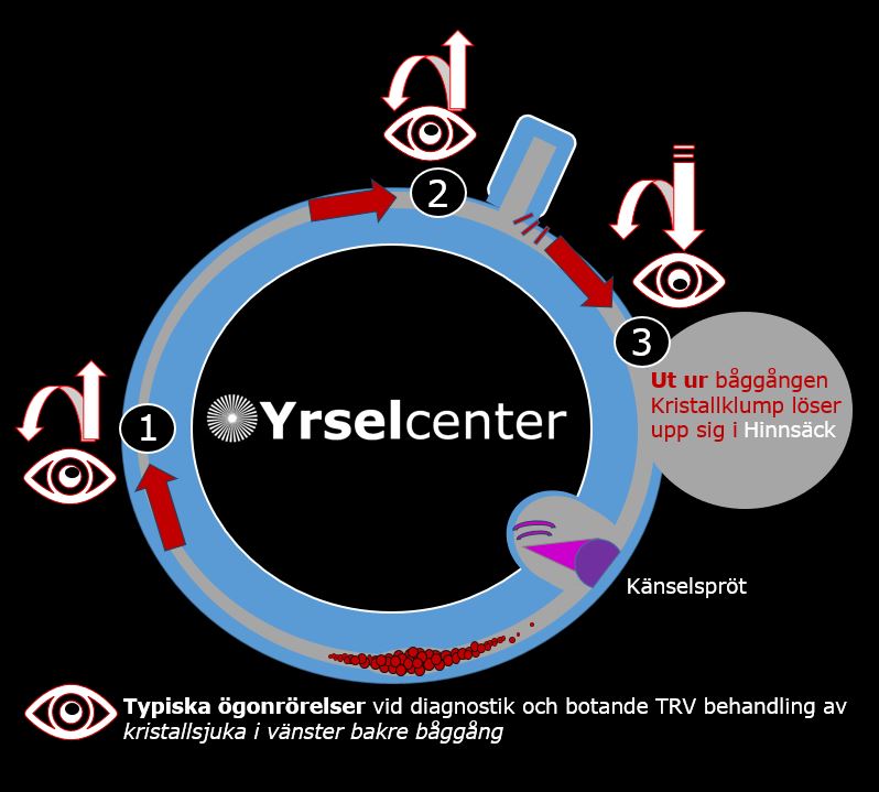 Typiska ogonrorelser vid kristallsjuka vae bakre baggang Yrselcenter